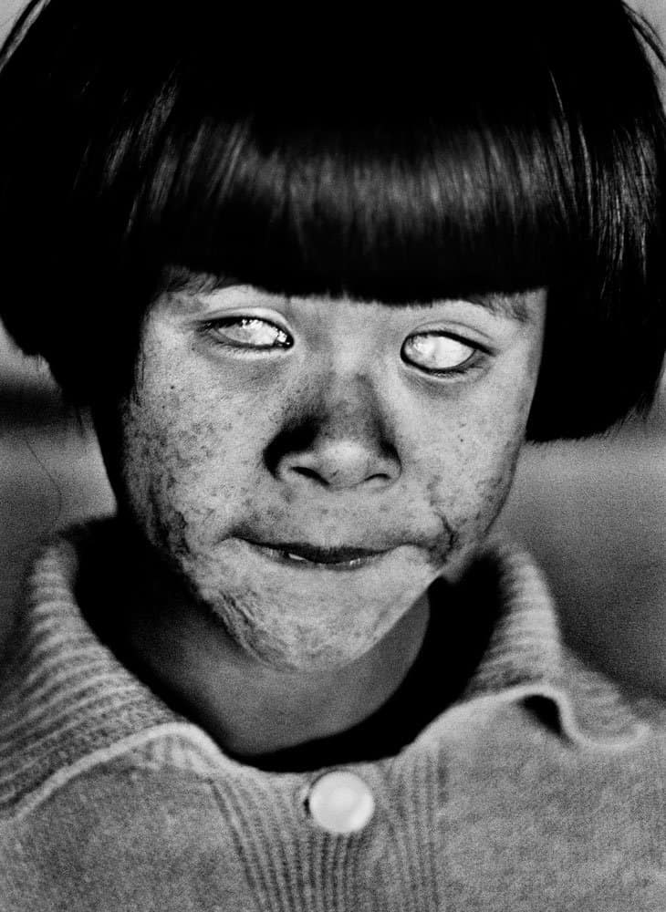 Närbild på en ung flicka med lugg som ser rakt fram med ljusa, blinda ögon.